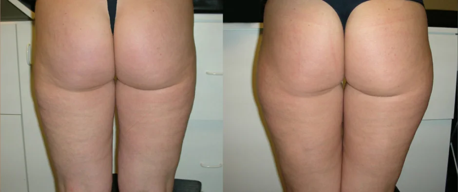 Thigh Lipo