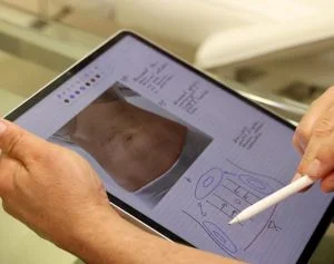 Diagram illustrating the 'Hourglass' liposuction technique during consultation, showing the three small incision points on the rib cage, pelvic bone, and flanks used to contour the waist.