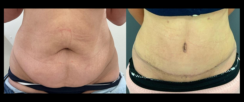 Full tummy tuck under 140 lb, before and after photos. Dr. William Andrade, Newmarket plastic surgeon serving Aurora.