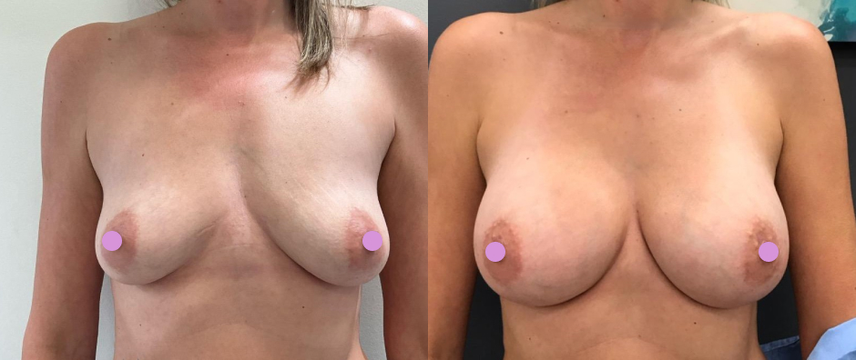 Breast augmentation 275cc, before and after photos. Dr. William Andrade, Newmarket plastic surgeon serving Aurora.