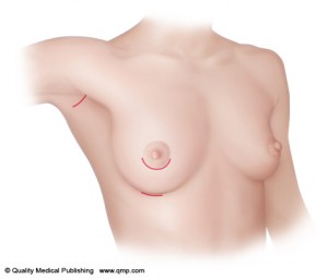 Location of the Incision - Breast Implants Newmarket, Barrie, Richmond Hill, Markham