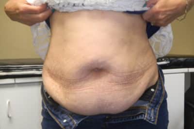Tummy Tuck Surgery Before