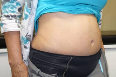 Abdominoplasty Surgery After