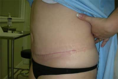 Abdominoplasty Surgery After