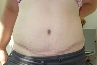 Tummy Tuck Surgery After