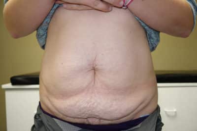 Tummy Tuck Surgery Before