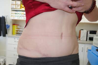 Abdominoplasty Surgery After
