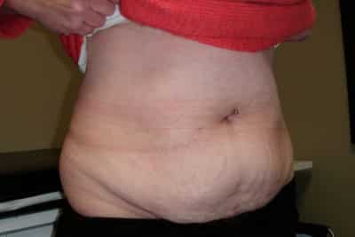 Abdominoplasty Surgery Before