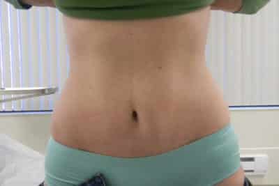 Tummy Tuck Surgery After