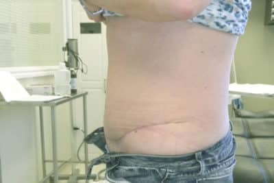 Abdominoplasty Makeover Barrie, Newmarket, Markham, Richmond Hill