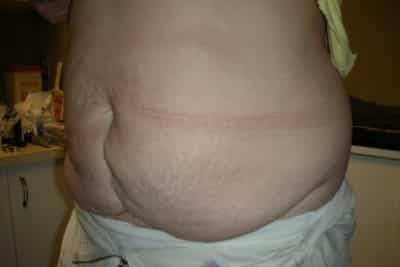 Tummy Tuck Surgery Plastic Surgeon Newmarket, Barrie