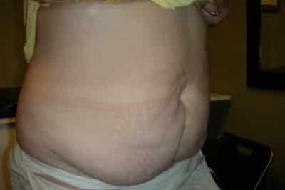 Abdominoplasty Surgery Plastic Surgeon Newmarket, Barrie
