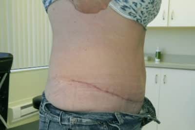 Abdominoplasty Surgery Plastic Surgeon Richmond Hill, Markham